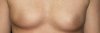 myboobsafter.jpg