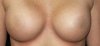 myboobsbefore.jpg